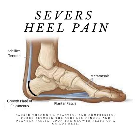 squeeze test for heel pain